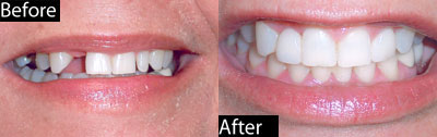Dental Bridge Before and After - Comprehensive Dentistry for All Ages in Lake Jackson TX