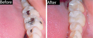 Dental Composite Natural Looking Fillings Before and After - Comprehensive Dentistry for All Ages in Lake Jackson TX