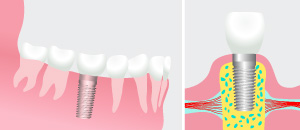 Dental Implants in Lake Jackson TX - Comprehensive Dentistry for All Ages