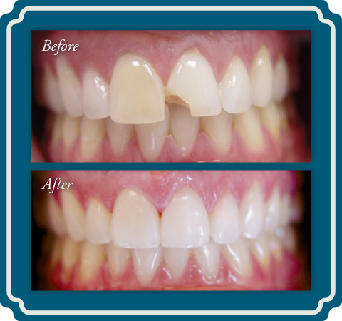 Porcelain Veneers at Lake Jackson TX Dentist Comprehensive Dentistry for All Ages